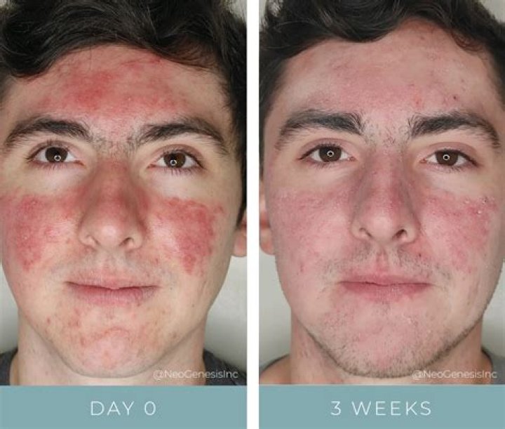 Would salicylic acid cause acne?
